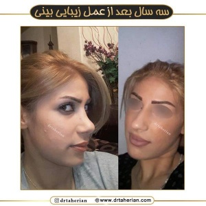 جراحی-بینی-652