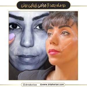 جراحی-بینی-660