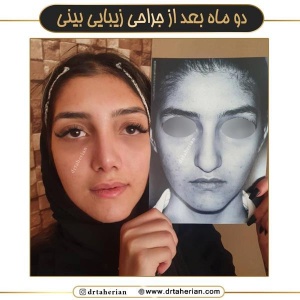 جراحی-بینی-666