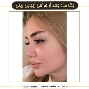 جراحی-بینی-668