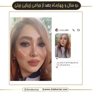 جراحی-بینی-670