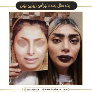 جراحی-بینی-674