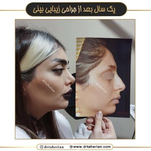 جراحی-بینی-675