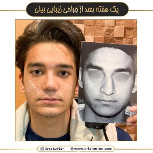 جراحی-بینی-700