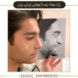 جراحی-بینی-701