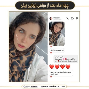 جراحی-بینی-702