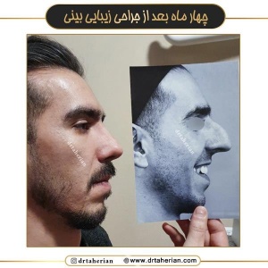 جراحی-بینی-703
