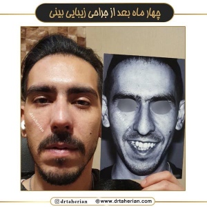 جراحی-بینی-704