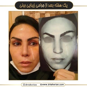جراحی-بینی-706