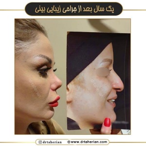 جراحی-بینی-709