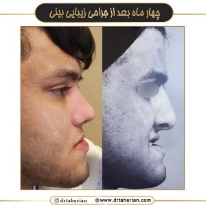 جراحی-بینی-710