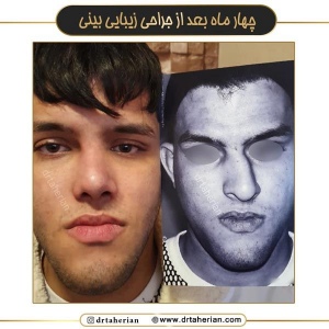 جراحی-بینی-711