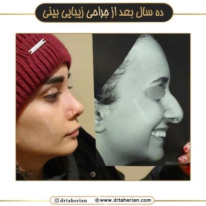 جراحی-بینی-712