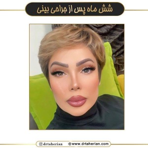 جراحی-بینی-714