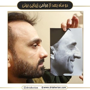 جراحی-بینی-715