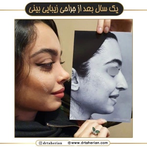 جراحی-بینی-717