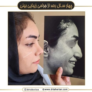 جراحی-بینی-720