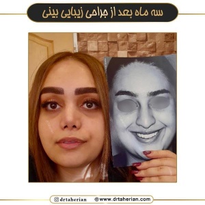 جراحی-بینی-721