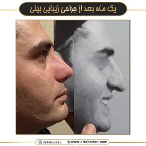 جراحی-بینی-724