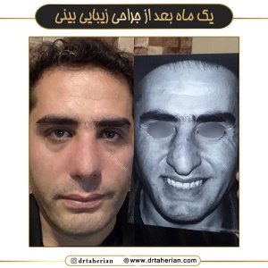 جراحی-بینی-725