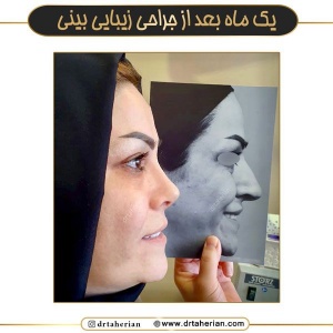 جراحی-بینی-728