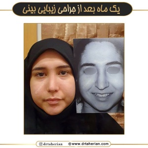 جراحی-بینی-730