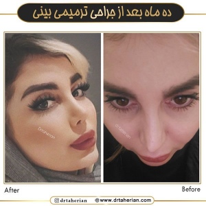 جراحی-بینی-733