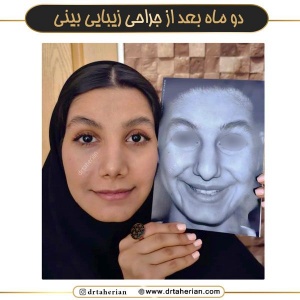 جراحی-بینی-740
