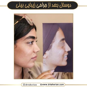 جراحی-بینی-741