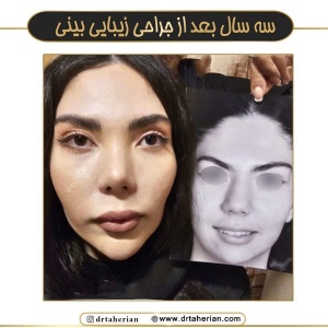 جراحی-بینی-742