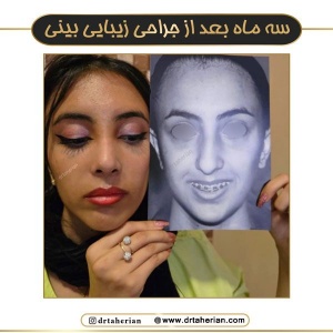 جراحی-بینی-744