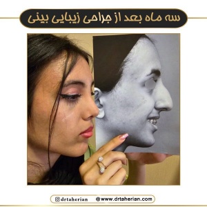 جراحی-بینی-745