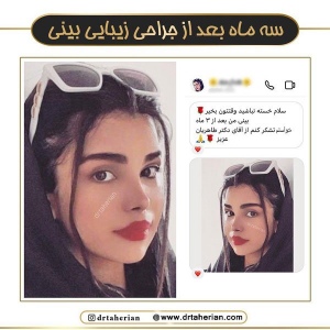 جراحی-بینی-746