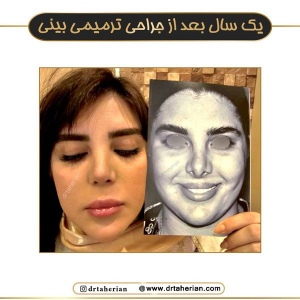 جراحی-بینی-747