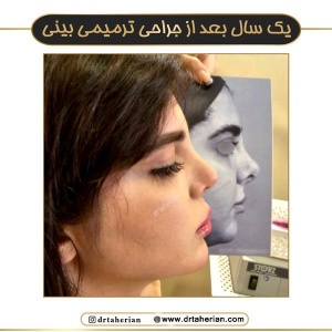جراحی-بینی-748