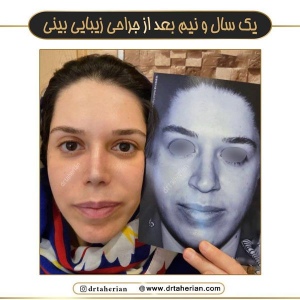 جراحی-بینی-751