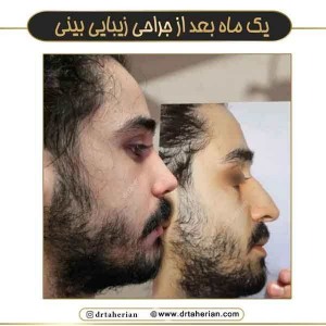 جراحی-بینی-752
