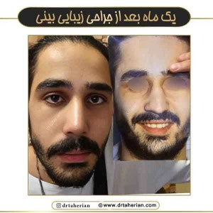 جراحی-بینی-754