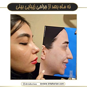 rhinoplasty-757