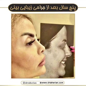 rhinoplasty-761