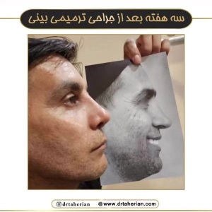 rhinoplasty-772