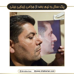 rhinoplasty-785