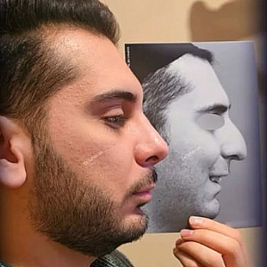 rhinoplasty-798