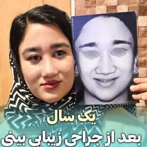 rhinoplasty-823