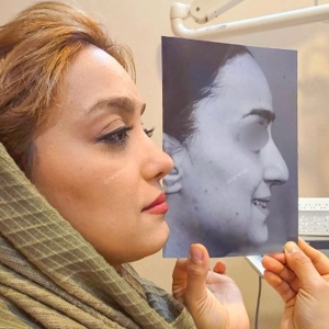 rhinoplasty-824