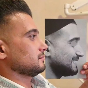 rhinoplasty-826