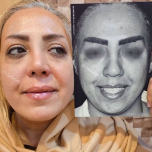 rhinoplasty-828