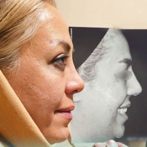 rhinoplasty-829