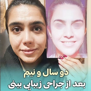 rhinoplasty-830