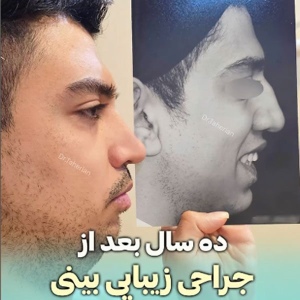 rhinoplasty-831